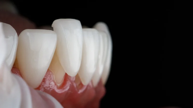 Can Teeth Grinding (Bruxism) Damage Veneers or Implants?