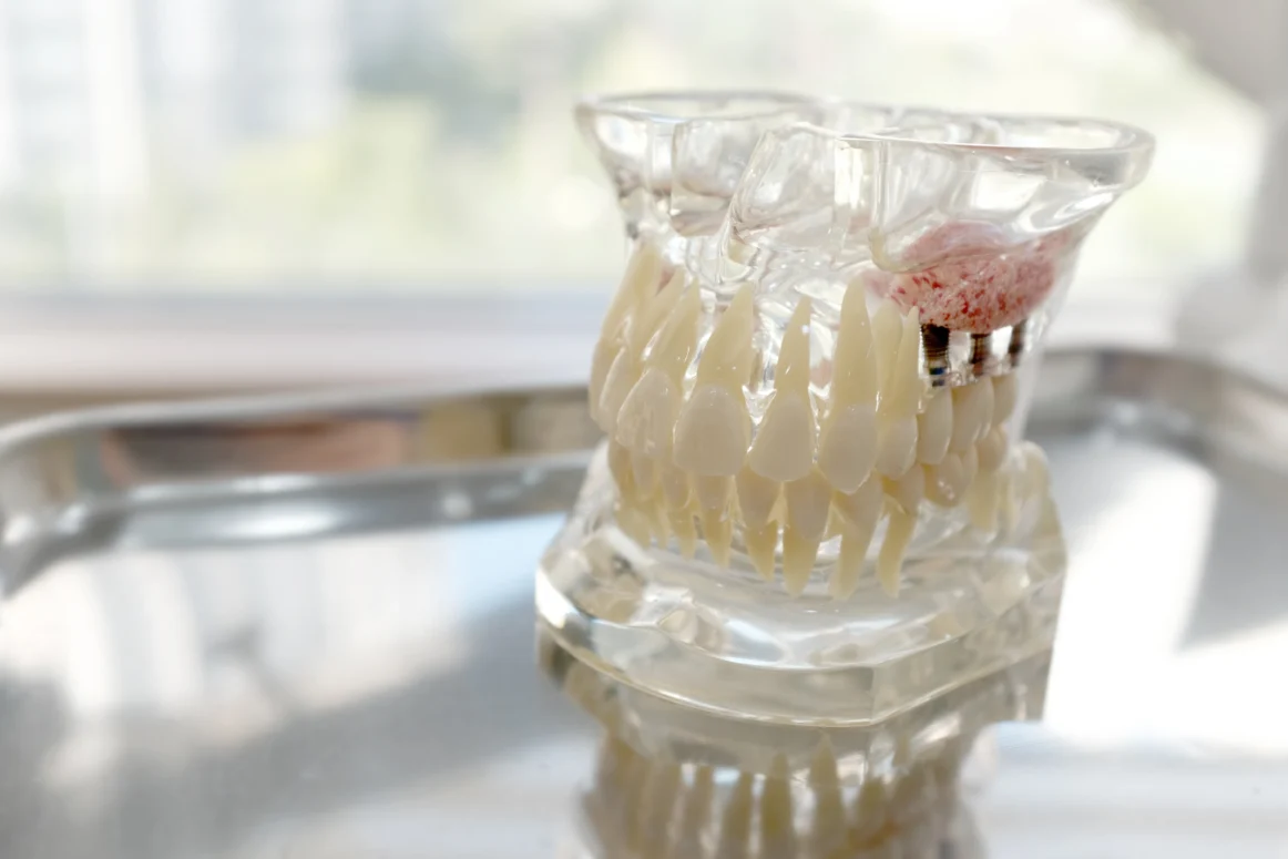 Bone Grafting