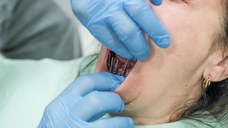 Multiple Teeth Replacement