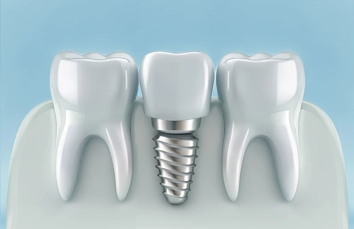 Tooth Implant