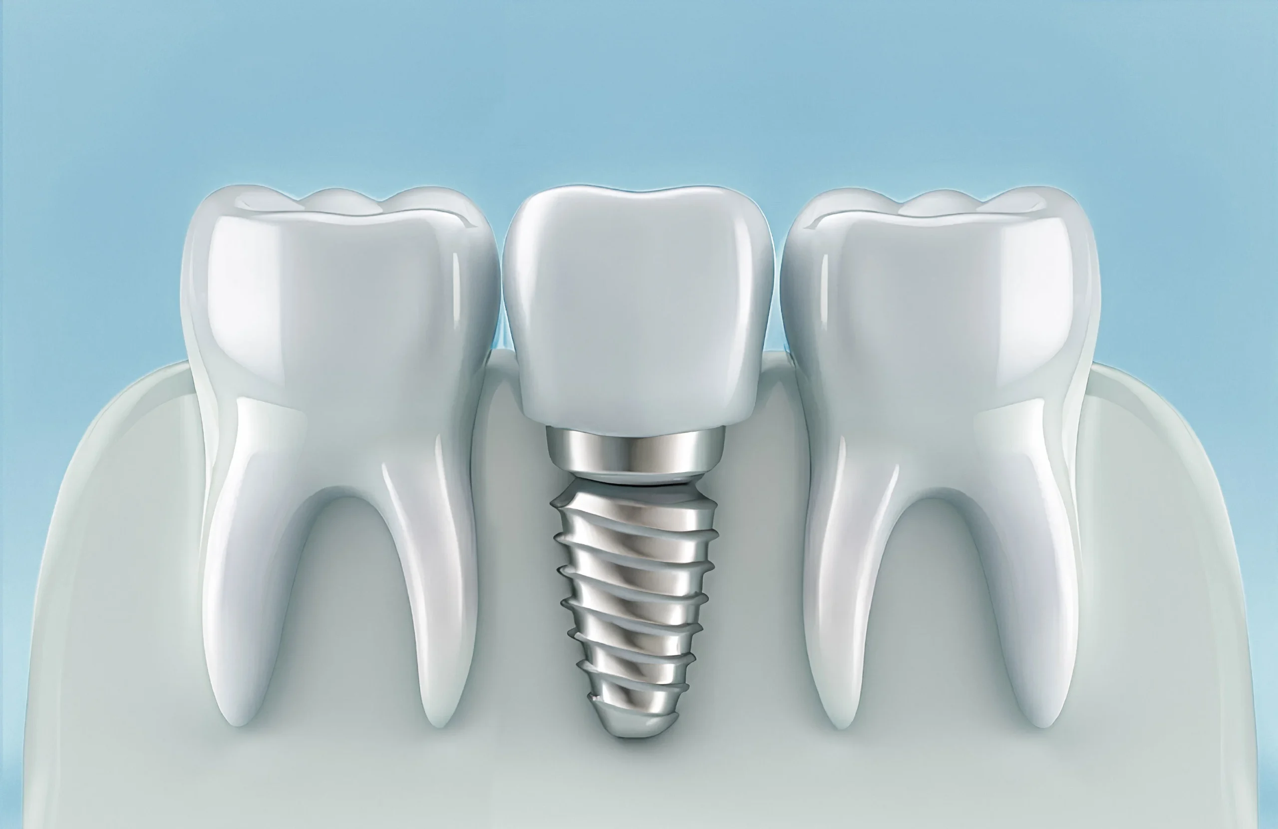 Tooth Implant Procedure in Türkiye: World-Class Quality at