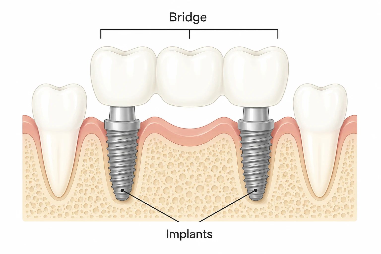 Bridge sur implant : trois dents remplacées par un bridge fixé sur deux implants