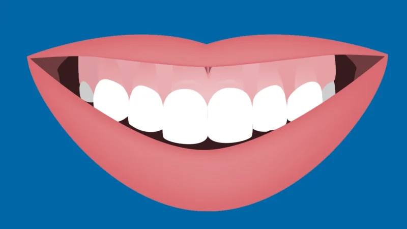Gummy Smile: Causes and Solutions