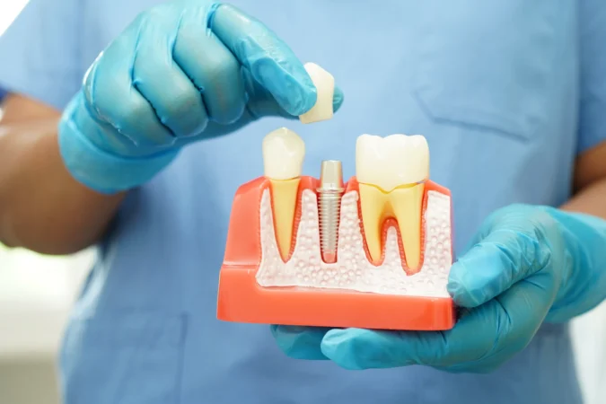 How Long Do Dental Implants Last?