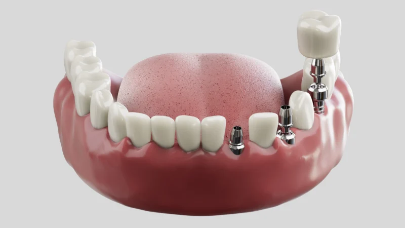 Dental Implant Surgery: Safe, Strong & Natural Tooth Replacement