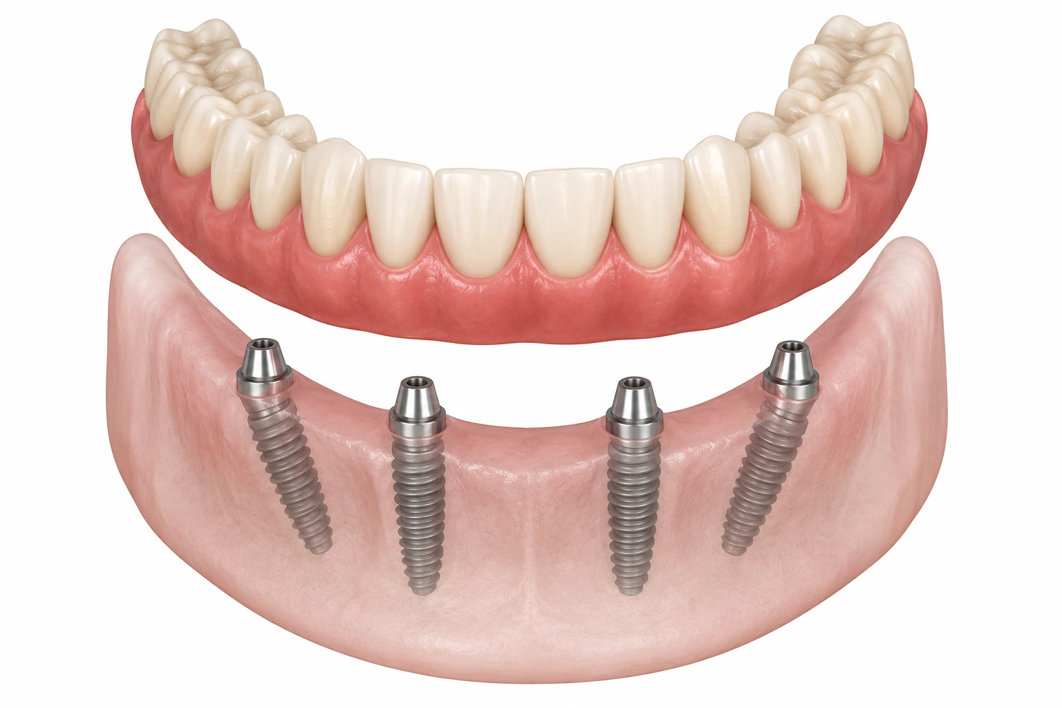 Medical illustration of a single full-arch All-on-4 dental implant bridge supported by four implants in the lower jaw, shown on a white background