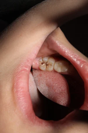Black Lines on Teeth: Causes, How to Remove Them, and Tips for Prevention