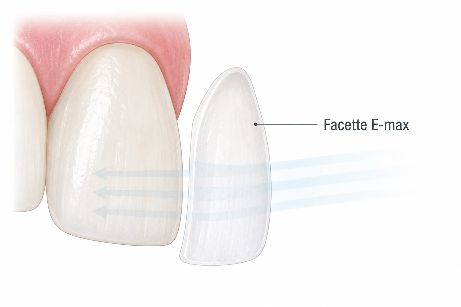 Facettes E-max : fine coque en céramique translucide posée sur la dent