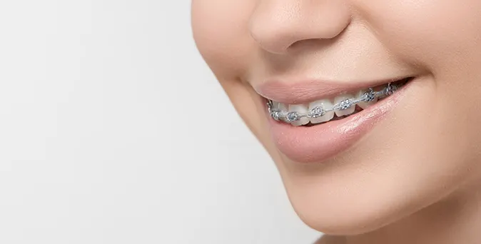 Preventive Orthodontics Myobrace