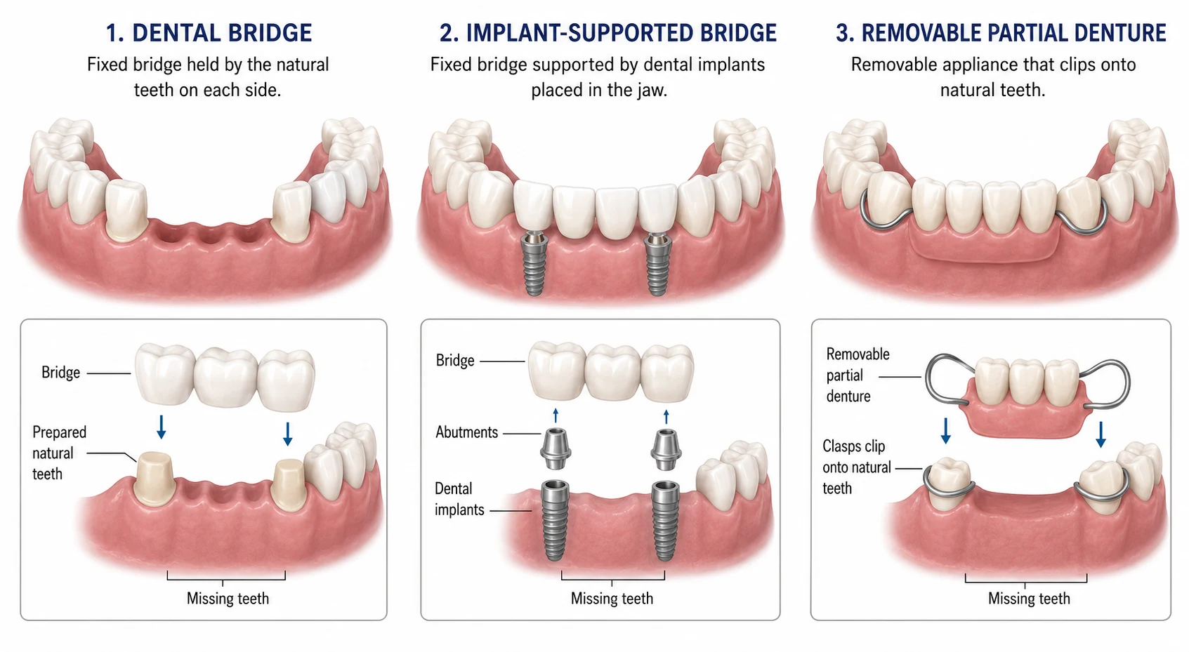 Three options to replace multiple missing teeth: dental bridge, implant-supported bridge, and removable partial denture