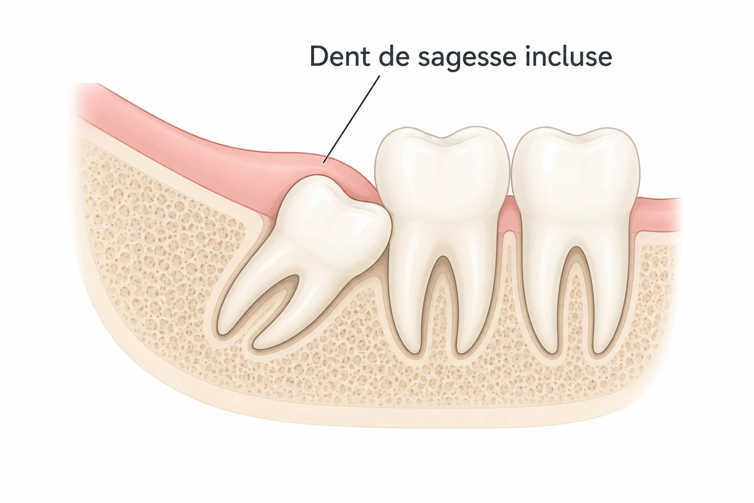 Extraction dent de sagesse : dent incluse poussant contre la dent voisine