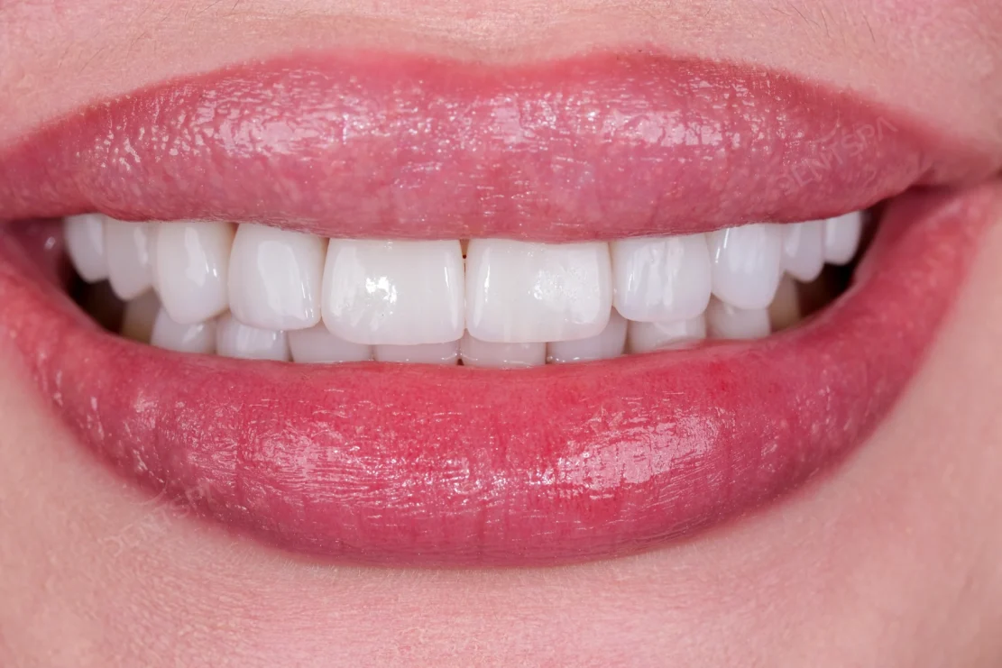 Dental Veneers: Veneer smile