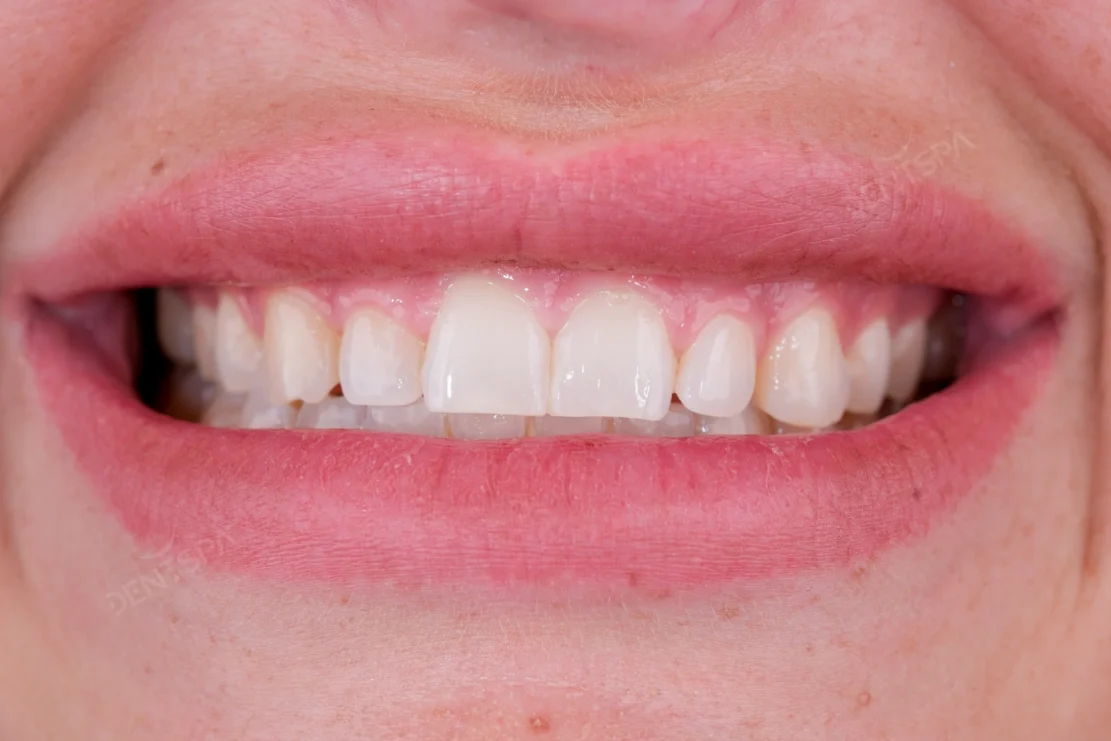 Dental Veneers: Veneer smile