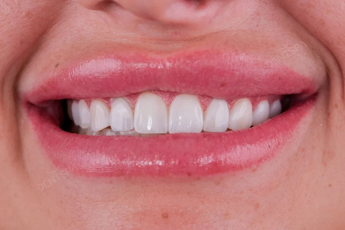 Dental Veneers: Veneer smile