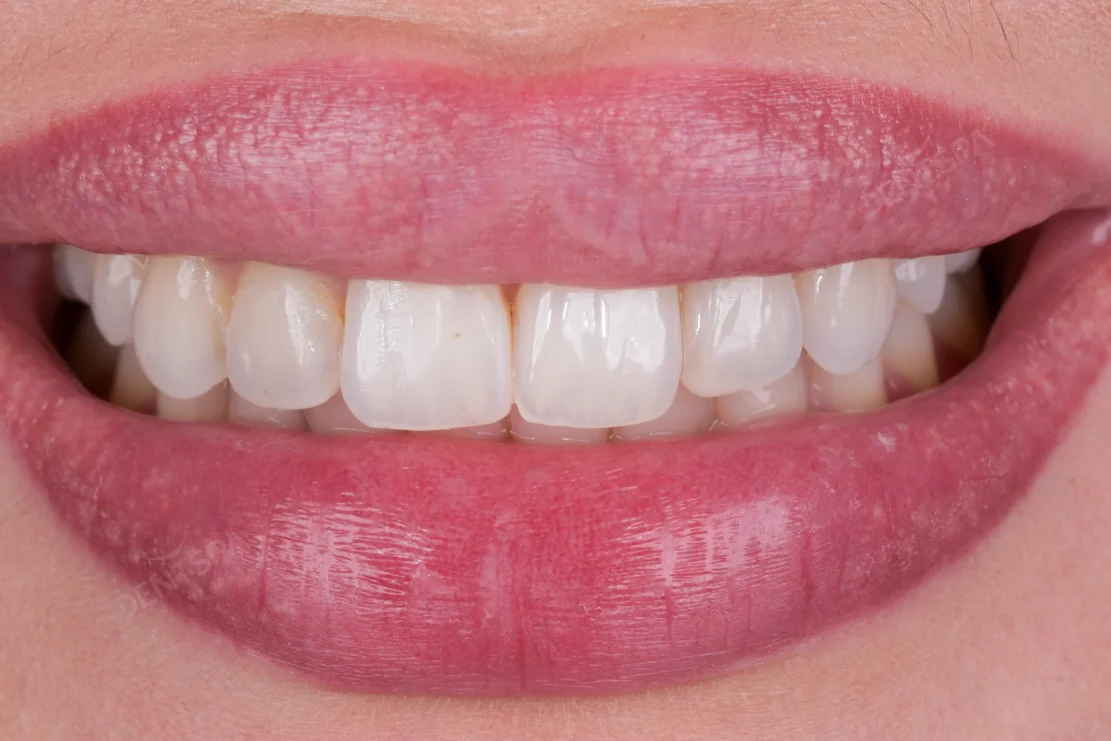 Dental Veneers: Veneer smile
