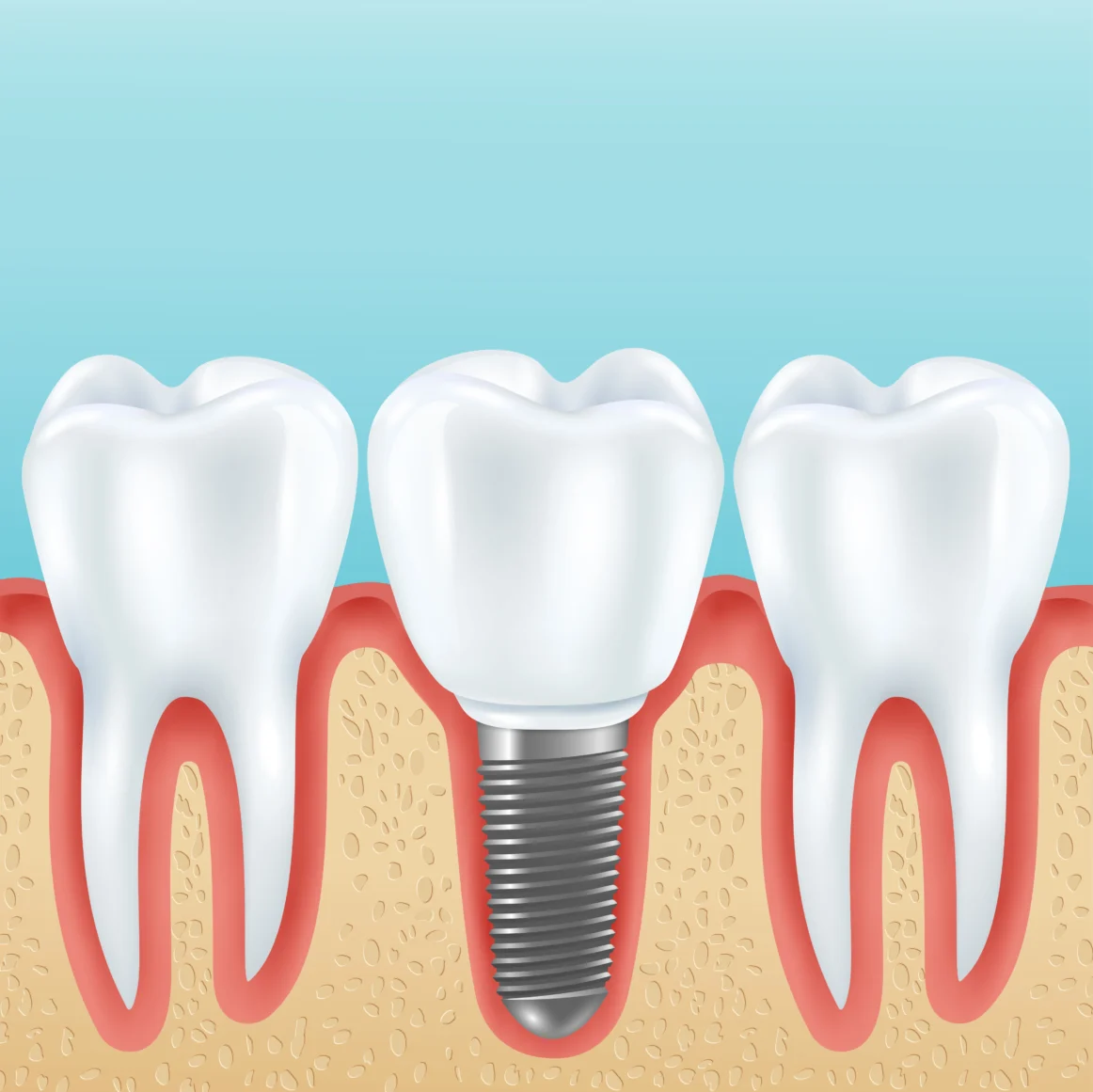 Titanium Dental Implants in Turkey: Your Trusted Path to a Lasting Smile