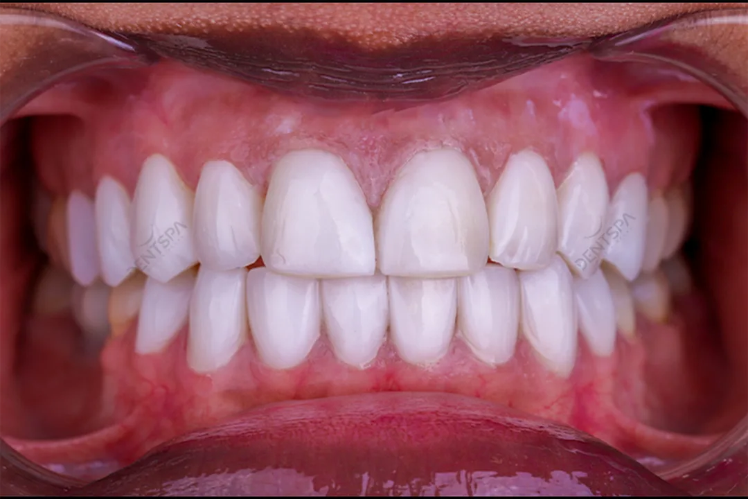 Composite Bonding: Tooth fixes
