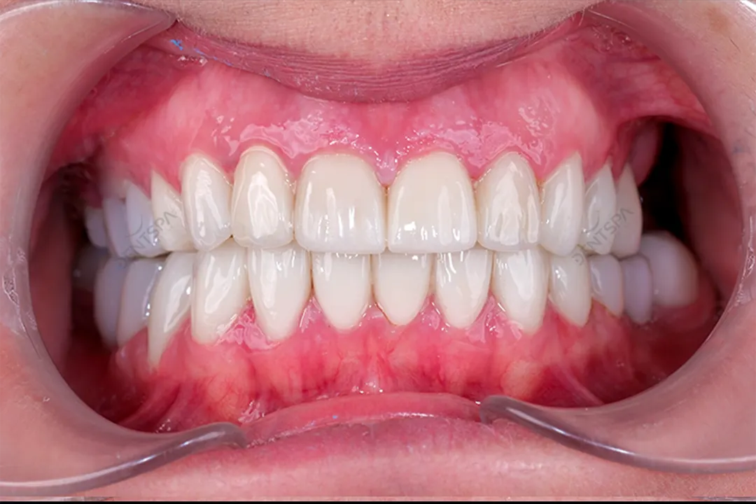 Dental Crowns: Dental caps