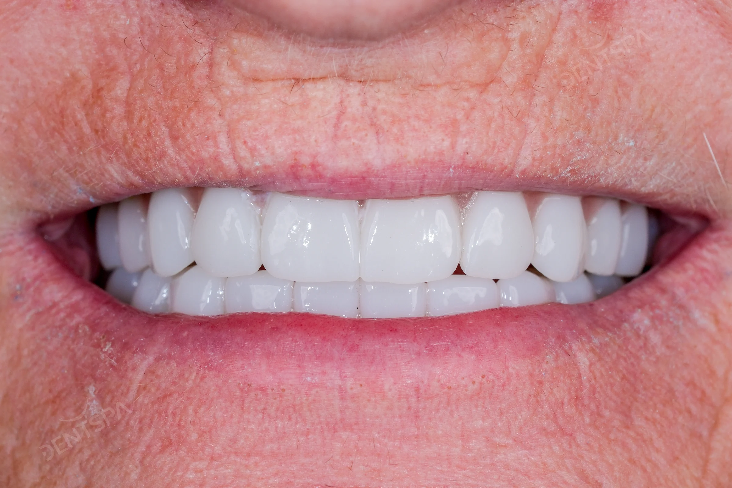 After: full implant restoration replacing multiple teeth at DentSpa