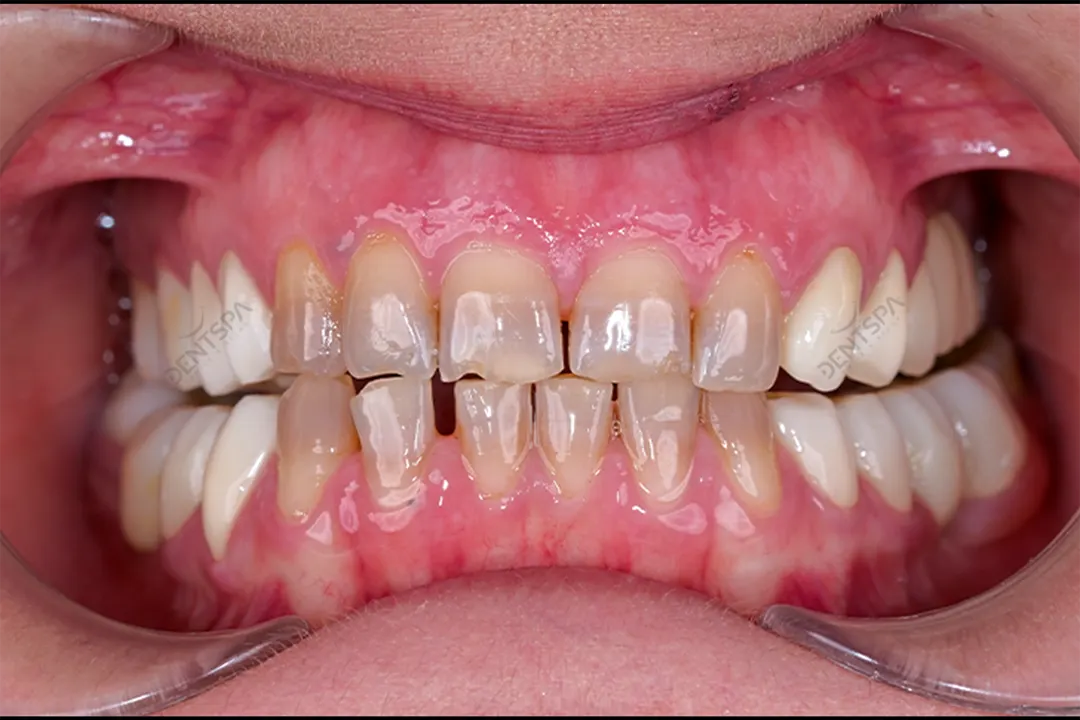 Dental Crowns: Dental caps