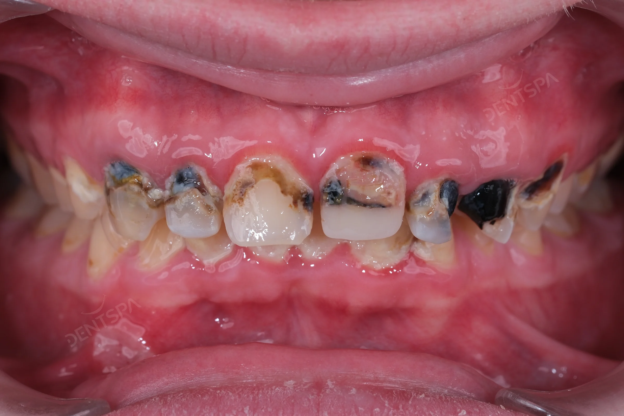 Before: front teeth restoration at DentSpa