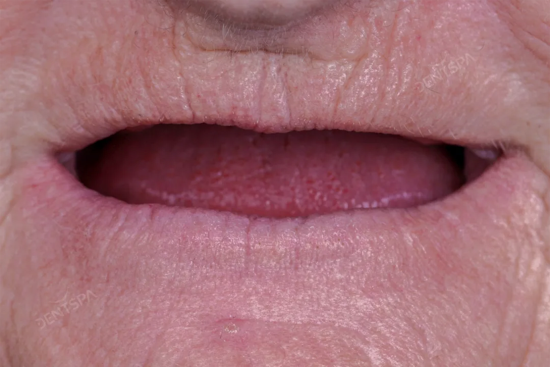 Implants for Multiple Teeth: Implant restoration