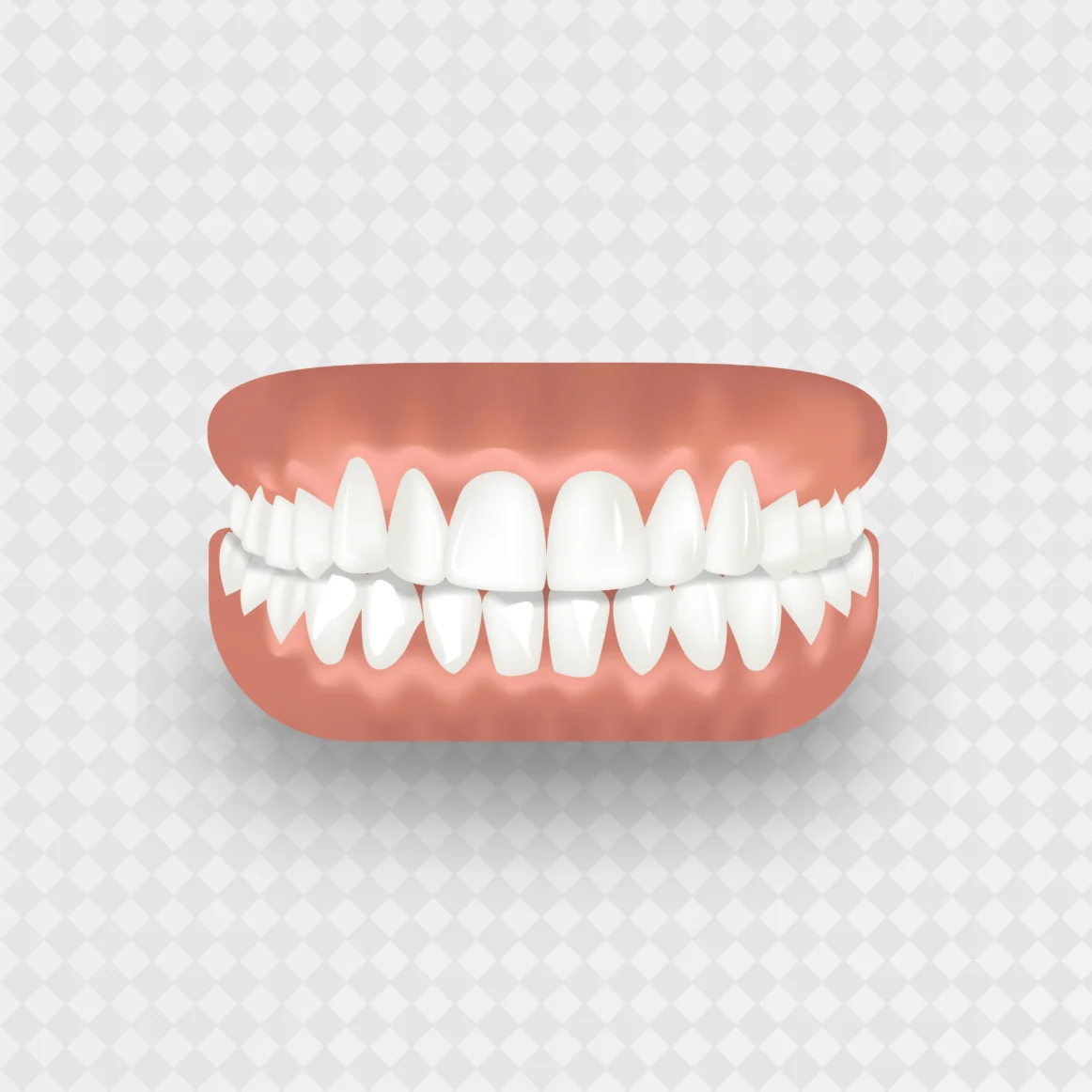 What is Deep Bite, And How Do You Treat It?