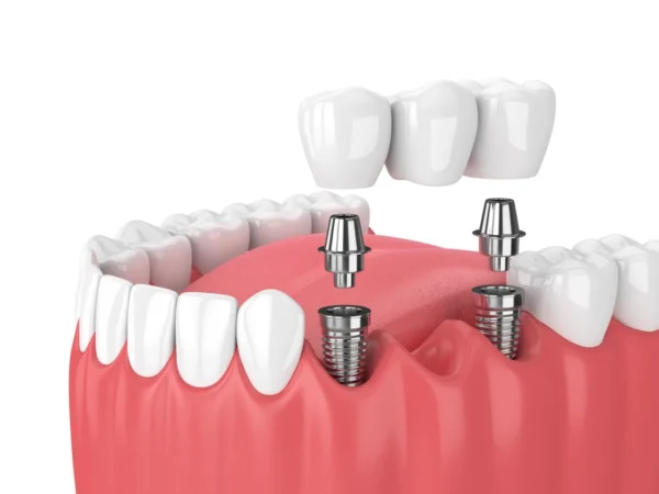 Titanium Dental Implants in Turkey: Your Trusted Path to a Lasting Smile