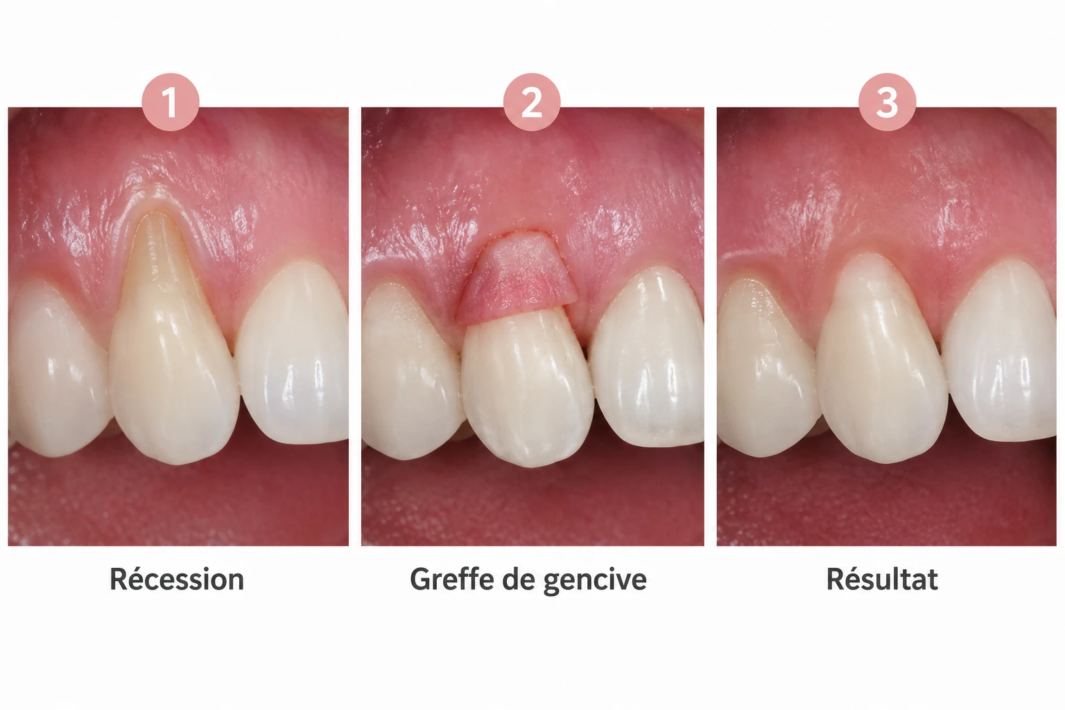 Déchaussement des gencives : traitement par greffe de gencive étape par étape