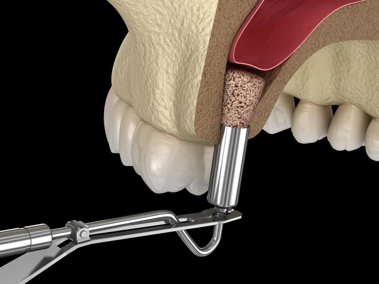 3D illustration of sinus lift surgery in Turkey showing sinus membrane elevation and bone graft placement in the upper jaw before dental implant.