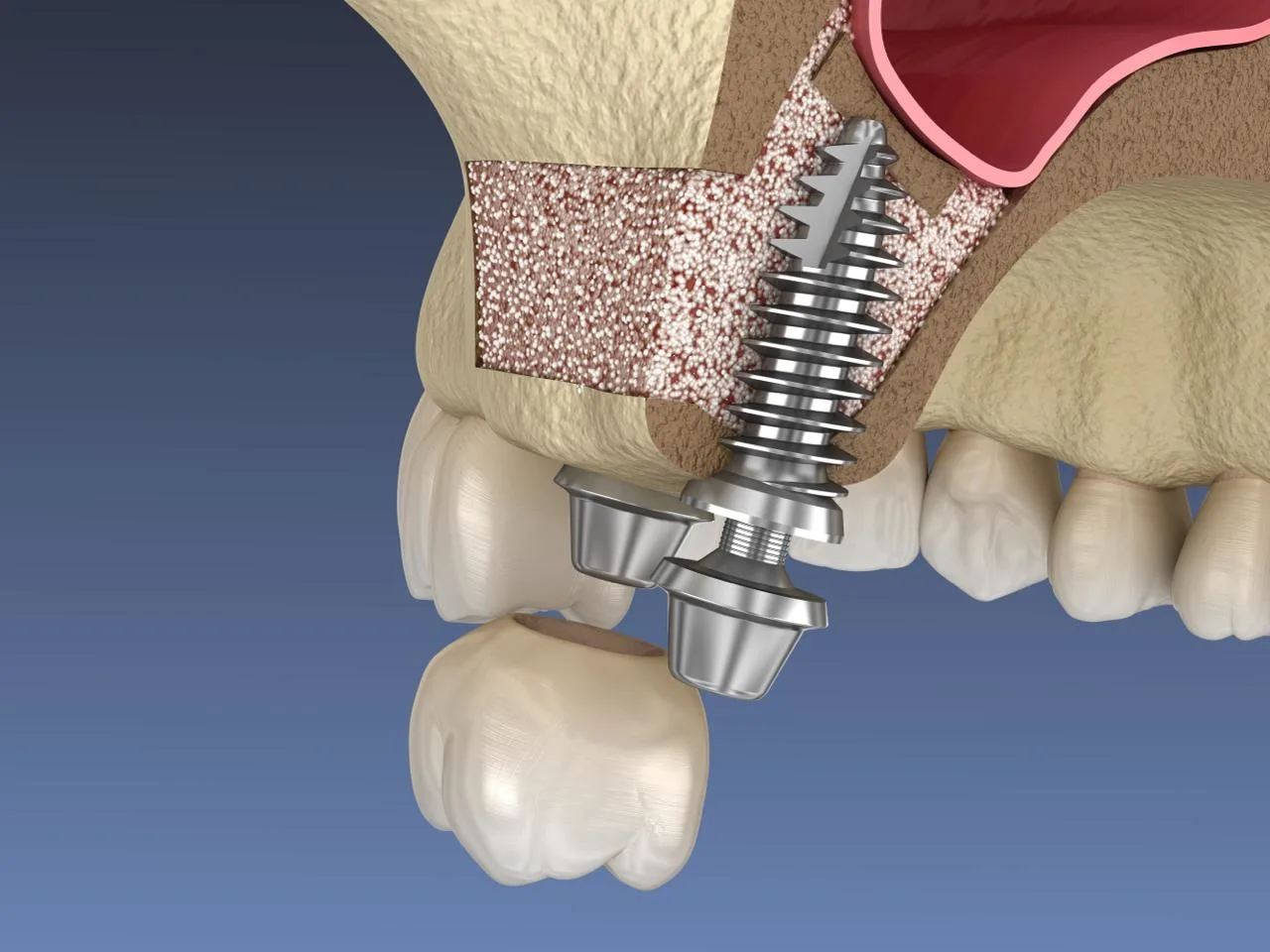 3D illustration of sinus lift with dental implant placement in Turkey, showing bone graft integration in the upper jaw after sinus augmentation.