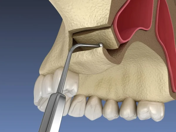 Everything You Need to Know About Sinus Lift Treatment in Turkey