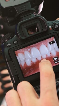 Hollywood Smile Turkey: The Ultimate Guide to Your Ideal Smile Makeover