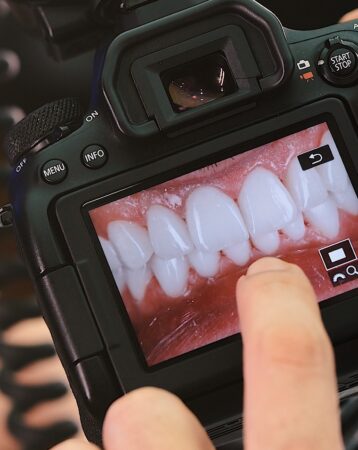 Hollywood Smile Turkey: The Ultimate Guide to Your Ideal Smile Makeover