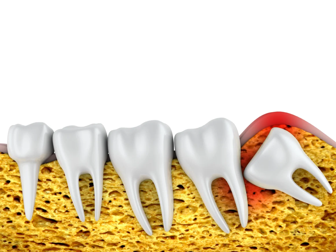 Lower Wisdom-Tooth Pain? Why Patients Choose Turkey for Safe, Affordable Care