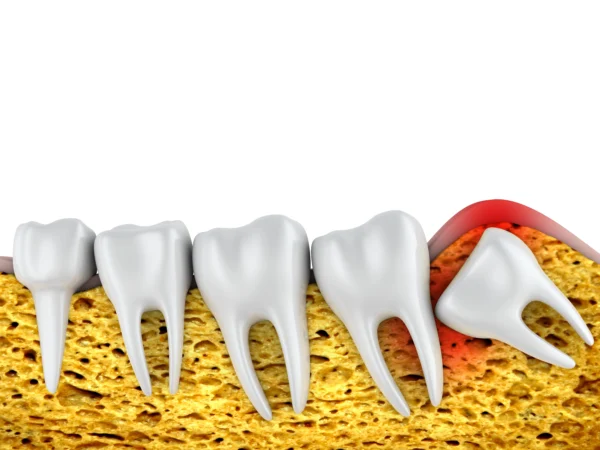 Lower Wisdom-Tooth Pain? Why Patients Choose Turkey for Safe, Affordable Care
