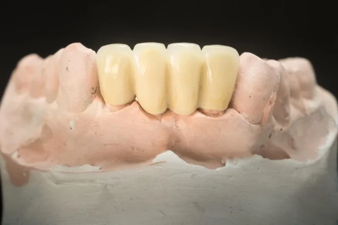 Removable Front-Tooth Replacement