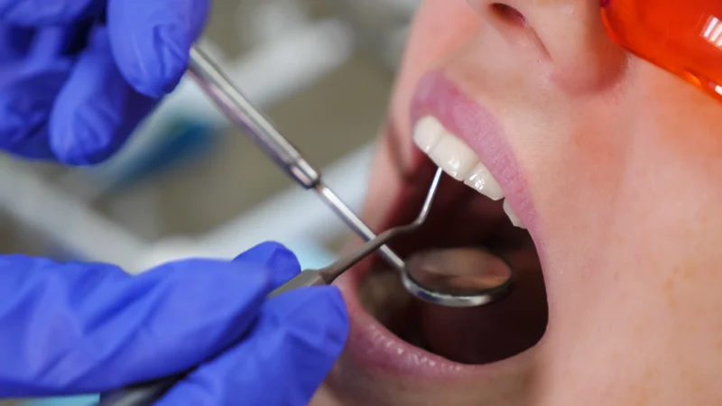 Amalgam Fillings in Turkey: Everything You Need to Know Before Restoring Your Smile