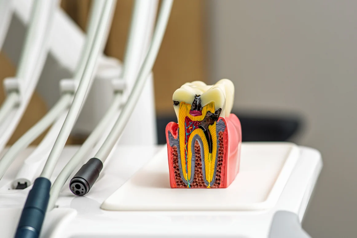 Traitement de canal ou extraction dentaire : Faire le bon choix pour votre sourire