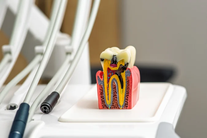 Traitement de canal ou extraction dentaire : Faire le bon choix pour votre sourire