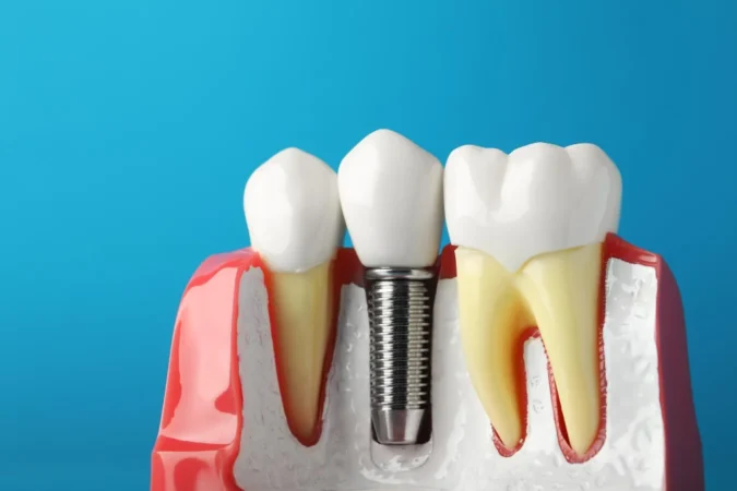 All-on-Six Dental Implants