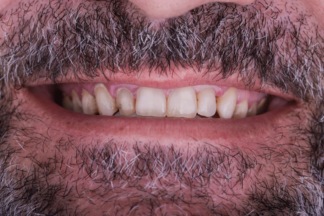 Stubborn Stains or Discolored Teeth
