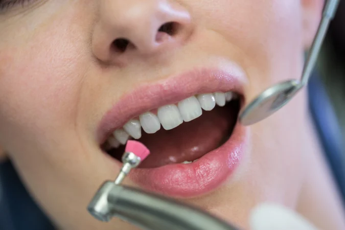 Can Veneers Be Whitened Safely?