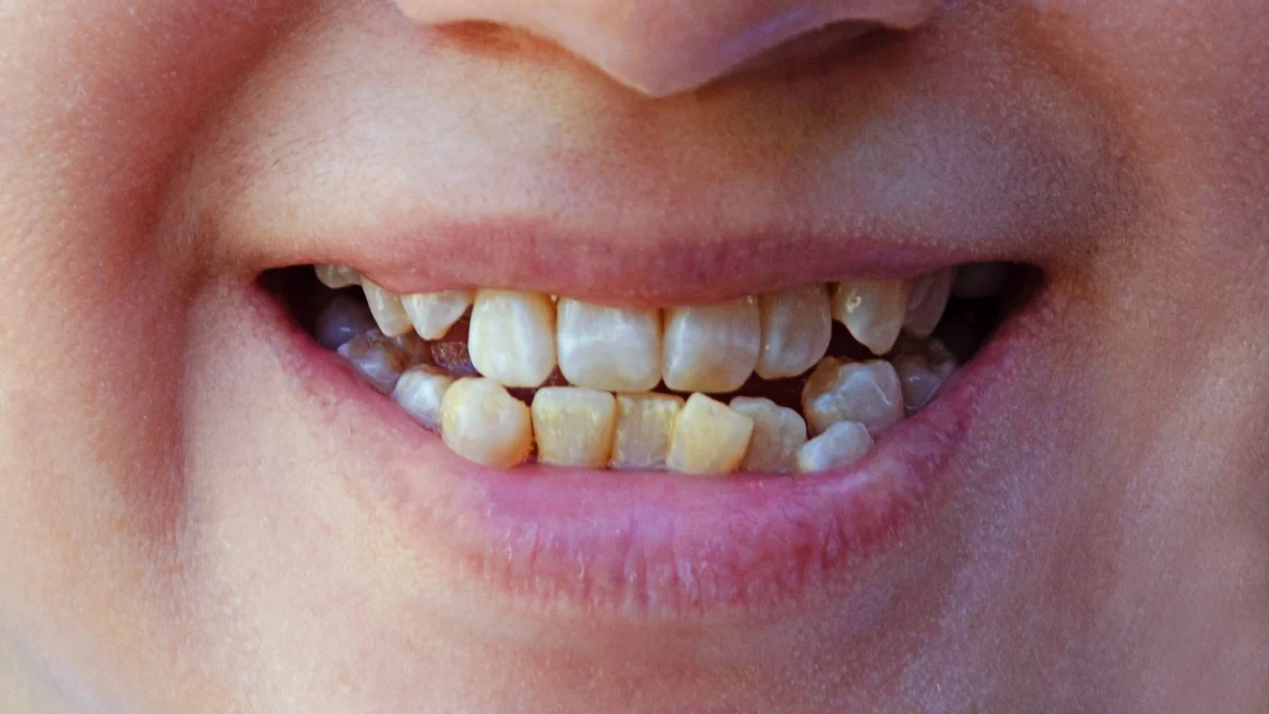 Crowded Teeth: Causes, Severity Levels, and the Best Treatment Options for Adults