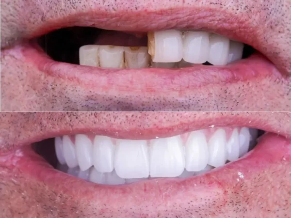 Full Mouth Dental Implants Abroad