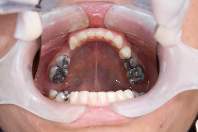 Removing Amalgam Fillings: Your Modern Smile Upgrade