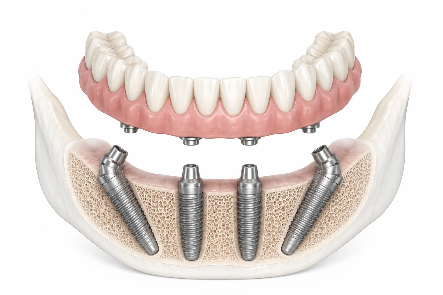 All-on-4 dental implants diagram showing four tilted implants supporting a full-arch bridge