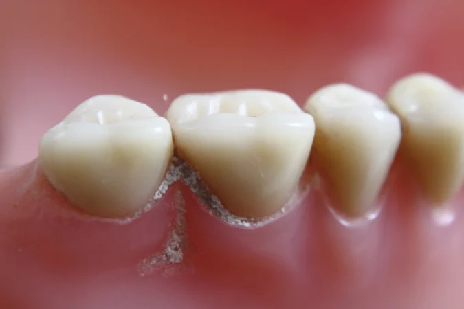 What Is Root Tooth Decay? (And Can a Tooth Still Decay After a Root Canal?)