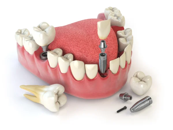 Immediate vs. Delayed Implant Placement: Which Option Is Right for You?