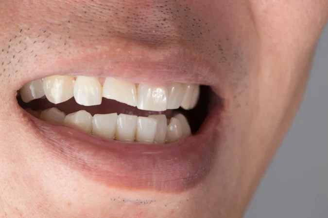 How to Fix a Chipped Front Tooth: Options & Cost
